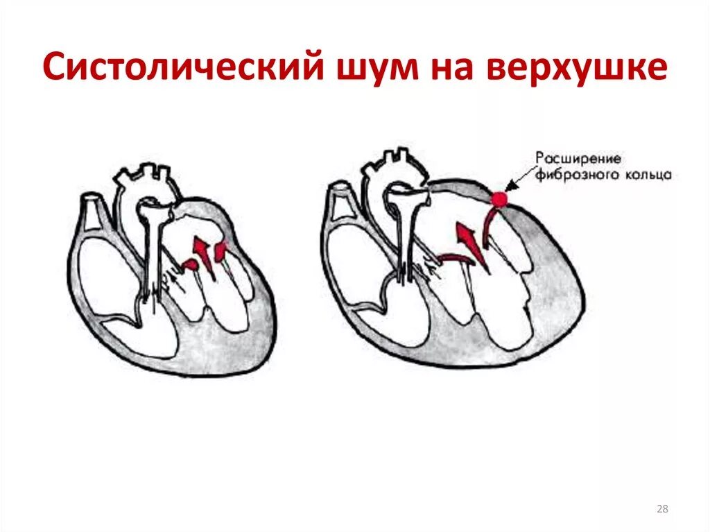 Систолический шум. Систолический шум на верхушке. Систолический шум на верхушке сердца причины. Функциональный систолический шум. Систолический шум это