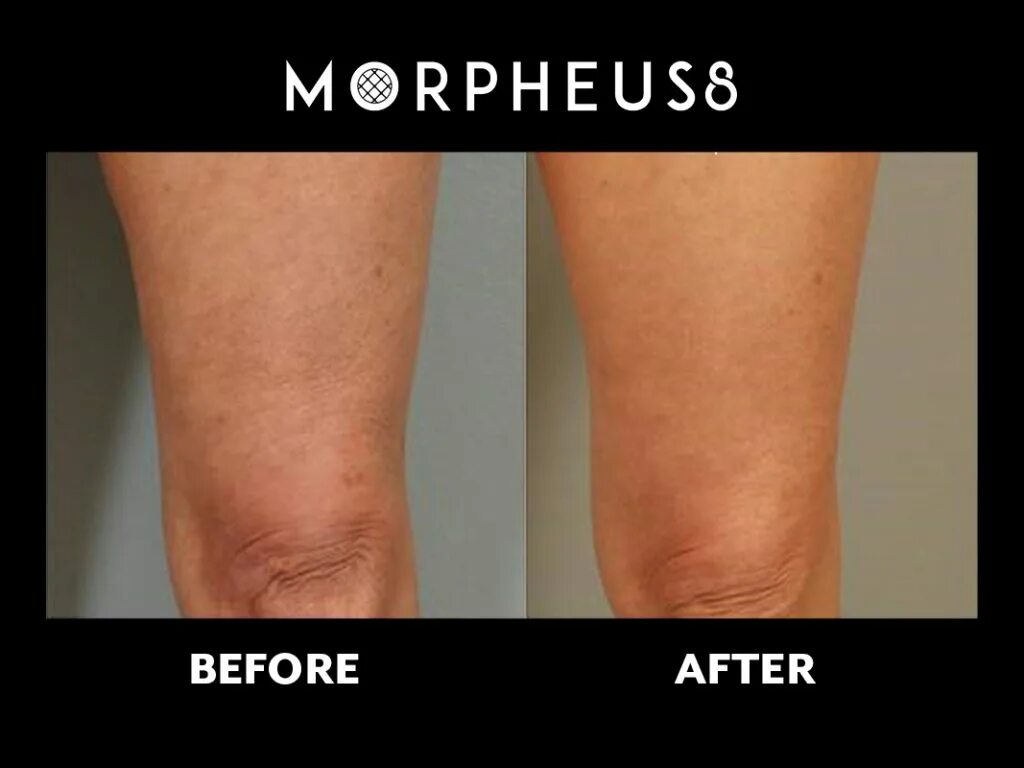 Микроигольчатый лифтинг morpheus. Микроигольчатый rf-лифтинг при растяжках.