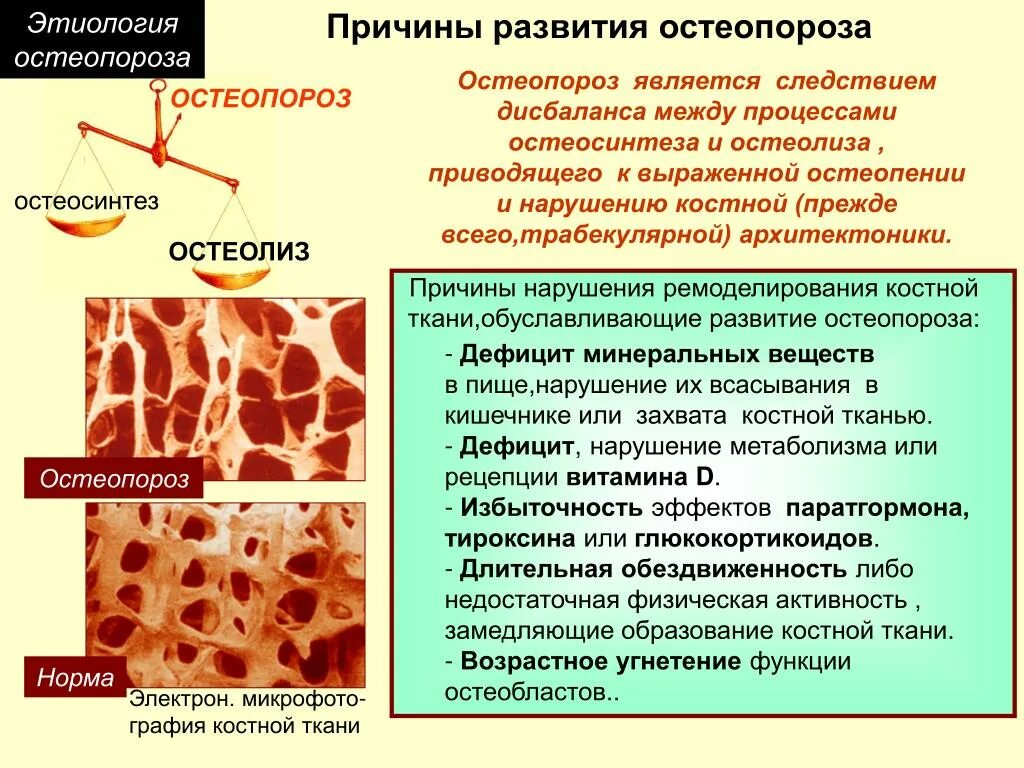 Структура костной ткани остеопороз. Структура костной ткани порозна что это. Остеопороз этиология. Основная причина развития остеопороза. Структурные изменения ткани