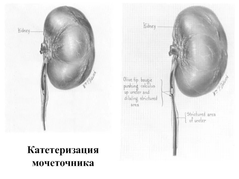 Катетеризация мочеточника