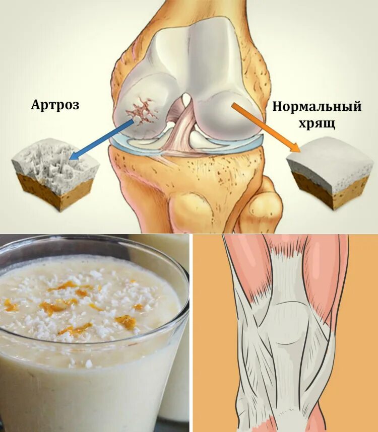 Усиленные суставы. Восстановление суставов. Укрепление костей. Укрепление суставов. Артроз коленного сустава.