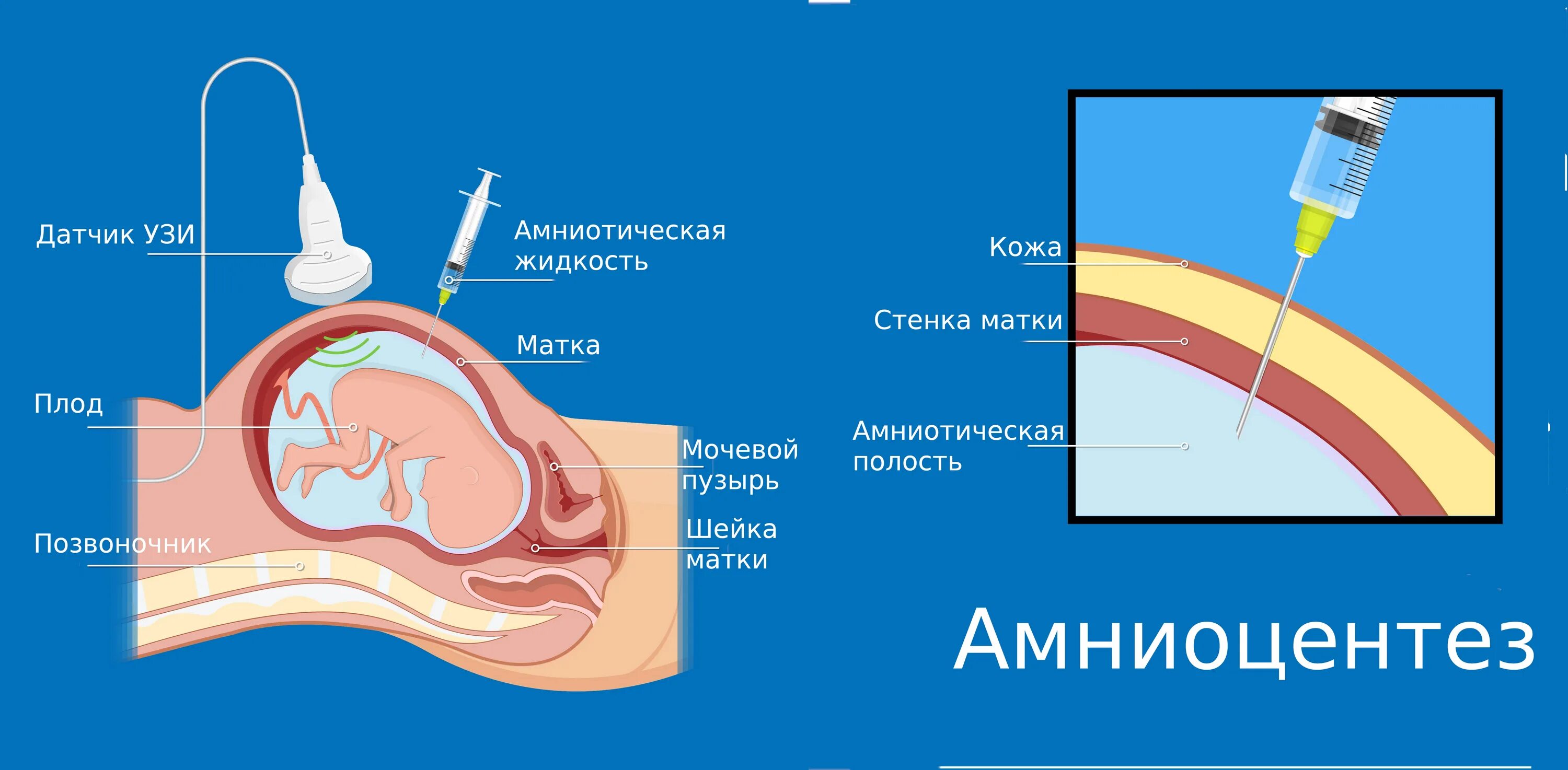 После прокола пузыря через сколько роды. Трансабдоминальный амниоцентез показания. Исследование околоплодных вод амниоцентез. Биопсия хориона амниоцентез кордоцентез. Схема проведения амниоцентеза.