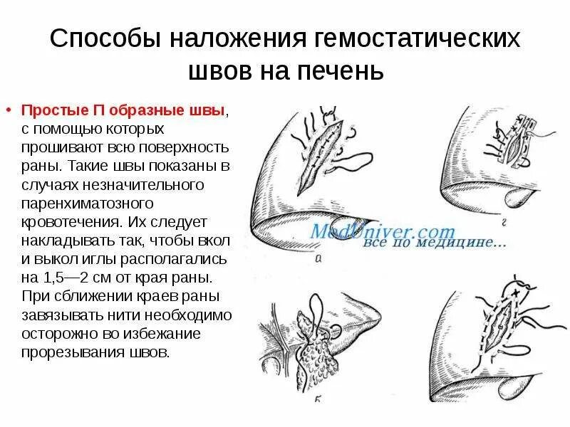 Шов паренхиматозных органов. Ушивание ран печени, шов кузнецова-пенского. гемостатические швы печени. шов печени топографическая анатомия.