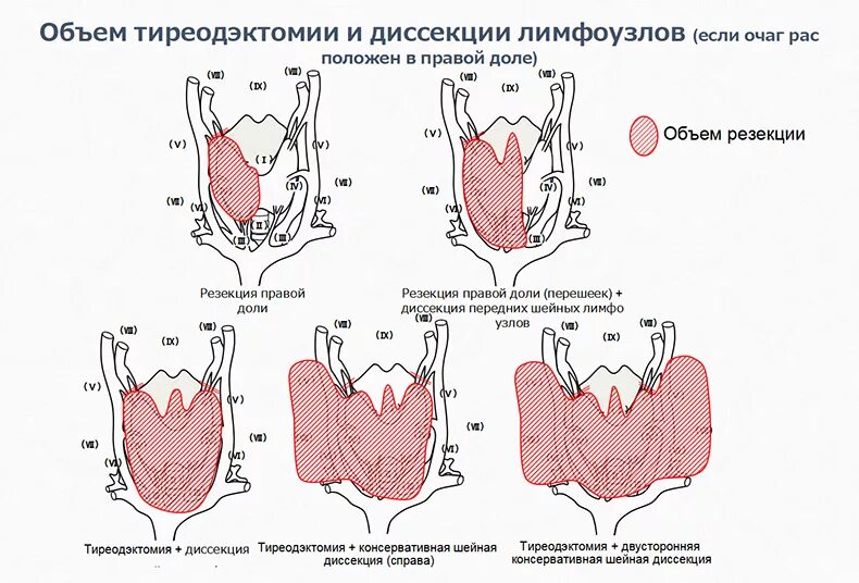 Сколько длится операция щитовидной. Субтотальная резекция щитовидной железы схема. Резекция доли щитовидной железы. Субтотальная резекция правой доли щитовидной железы. Резекция перешейка щитовидной железы.