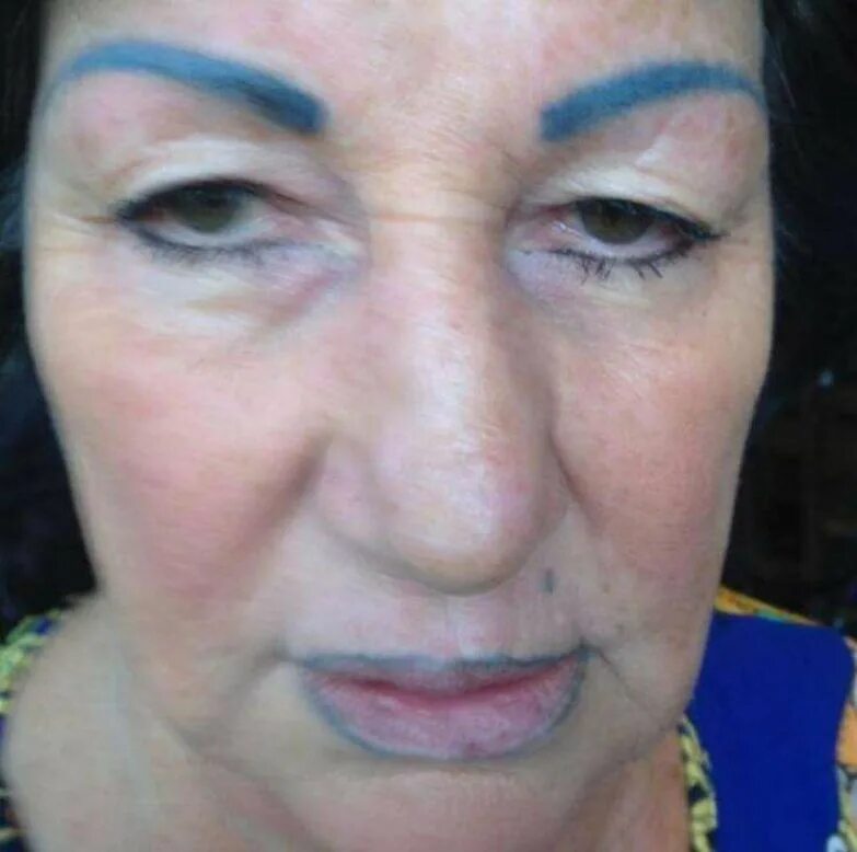 Синие губы у пожилых. Пожилая женщина открыла рот. Пожилые женщины с открытым ртом. Синие губы у пожилых. Хейлит мелькерссона -розенталя.