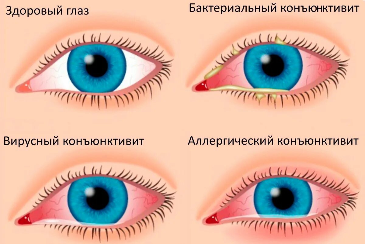 Красность. Аденовирусная инфекция бактериальный конъюнктивит. Аденовирусный конъюнктивит глаз. Бактериальный конъюнктивит Гнойный. Герпетический вирусный конъюнктивит.