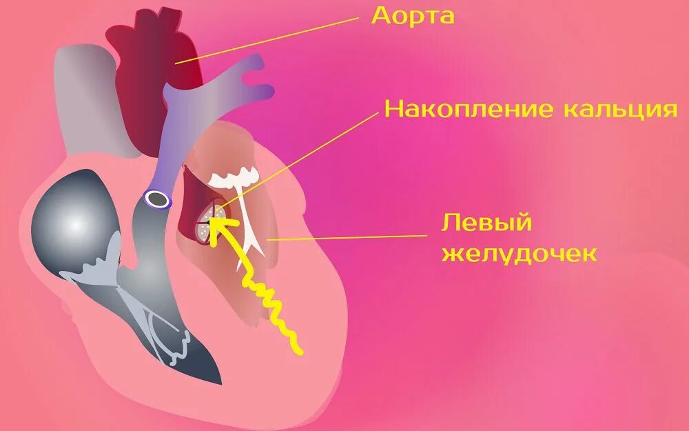 Кальцинация сосудов