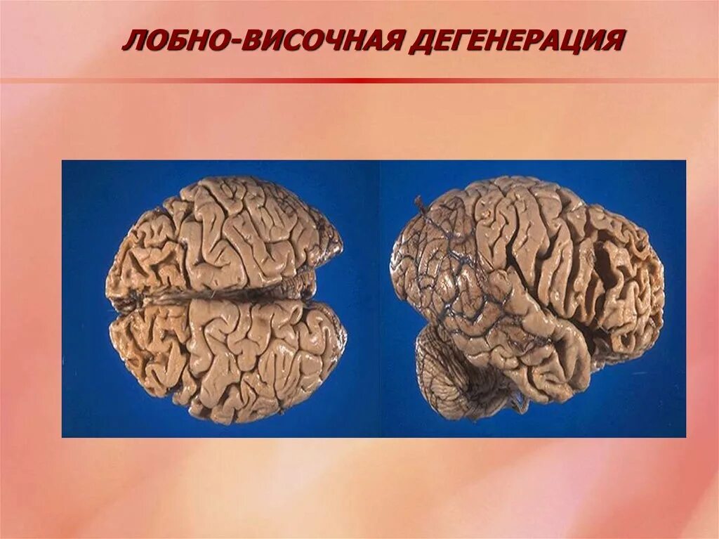 Лобная деменция симптомы. Лобно височная деменция болезнь пика. Лобно височная дегенерация болезнь пика. Болезнь Ниманна пика мрт. Деменция лобно-височной доли.