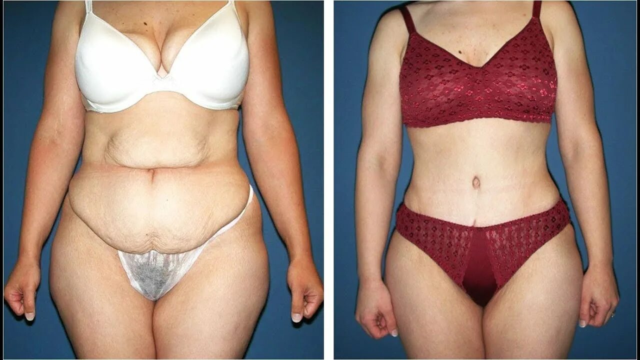 Вытечет обрюзгший жир. Вытечет обрюзгший жир. Липосакция фартука живота. Жир на боках. Липоскульптура живота до и после.
