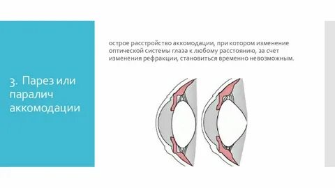 H 52.5 нарушения аккомодации