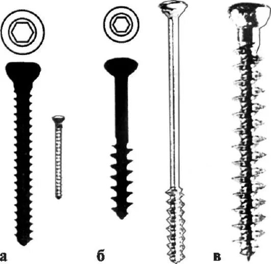 Остеосинтез акс крючковидной пластиной. Остеосинтез пяточной кости винтами. Остеосинтез большеберцовой пластиной. Кортикальные винты для остеосинтеза. Биодеградируемые винты для остеосинтеза.