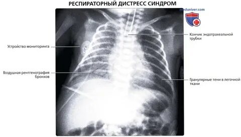 Аспирационный синдром у новорожденных