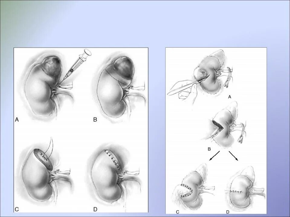 Резекция почки что это. Нефрэктомия, резекция почки швы. Лапароскопическая нефрэктомия этапы операции. Радикальная нефрэктомия почки. Нефрэктомия ход операции.