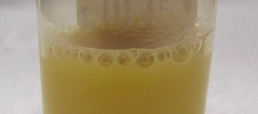 мутная грязная моча. молочная моча у ребенка. молочная моча у ребенка. мутность мочи. липурия, хилурия.