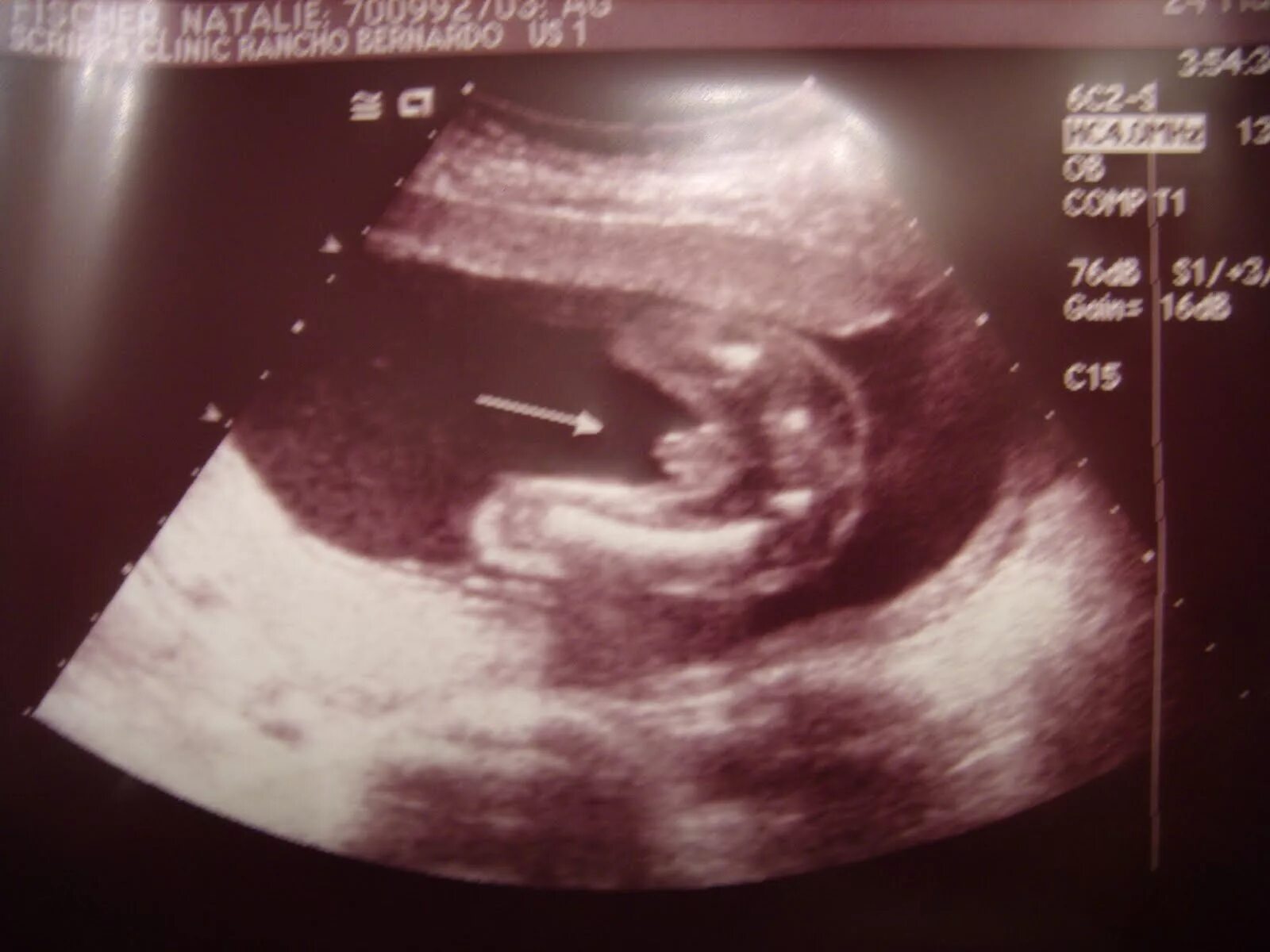 УЗИ 17-18 недель беременности. 19 неделя отзывы