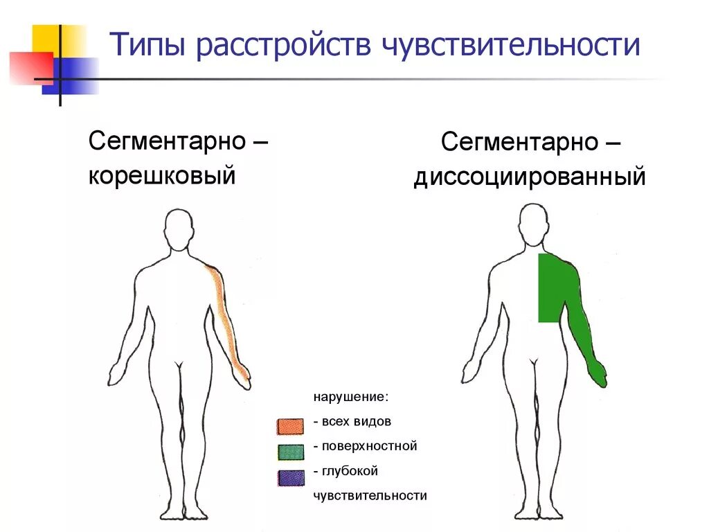 Типы поражения чувствительности. Сегментарный проводниковый Тип расстройства чувствительности. Сегментарный диссоциированный Тип расстройства чувствительности. Корешковый Тип нарушения чувствительности. Корешковый Тип нарушения чувствительности рисунок.