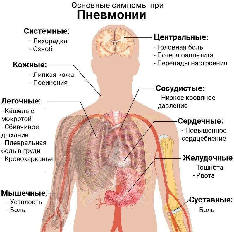 Боли при заболеваниях легких. Пневмония кратко о болезни. Клиническая картина пневмонии у взрослых.