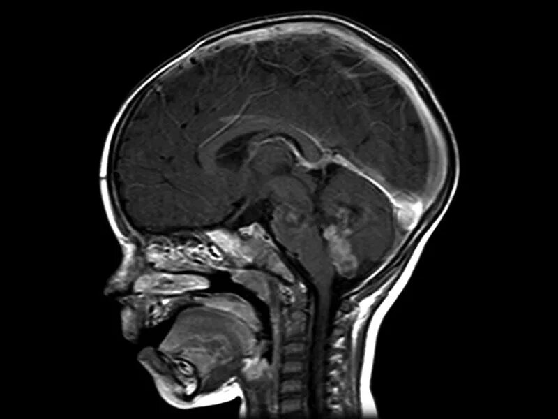 Мрт головного мозга ребенку. Мрт головного мозга у детей норма. Кт томограмма головного мозга. Мрт мозга что покажет у ребенка. Кт томограмма головного мозга.