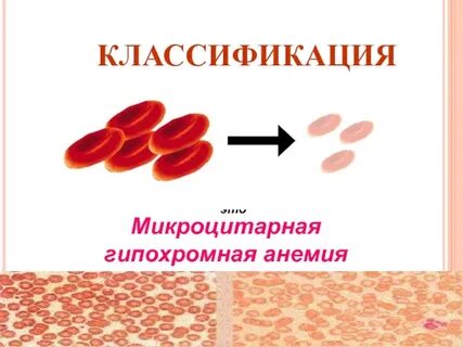 Микроцитарная анемия