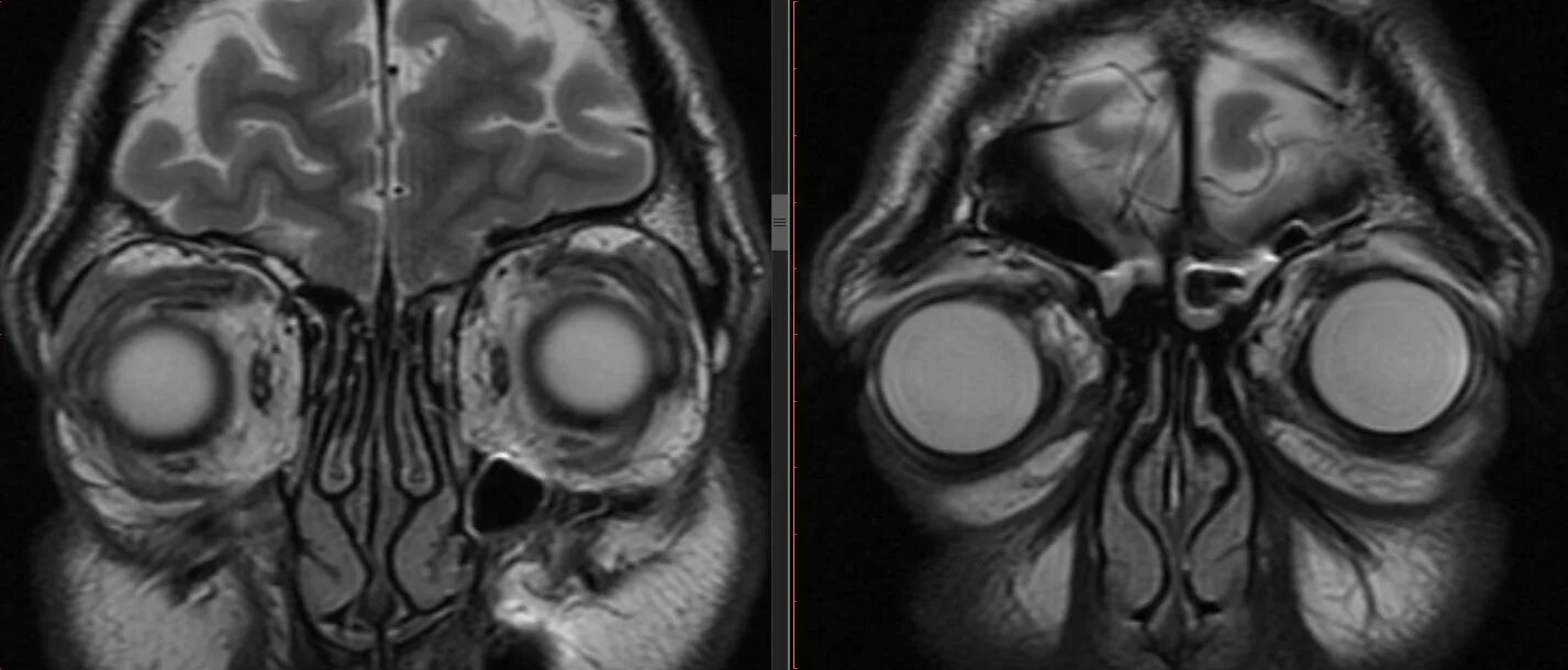 Мрт орбит и зрительных нервов. Мрт глазницы и зрительного нерва. Мрт головного мозга и орбит.