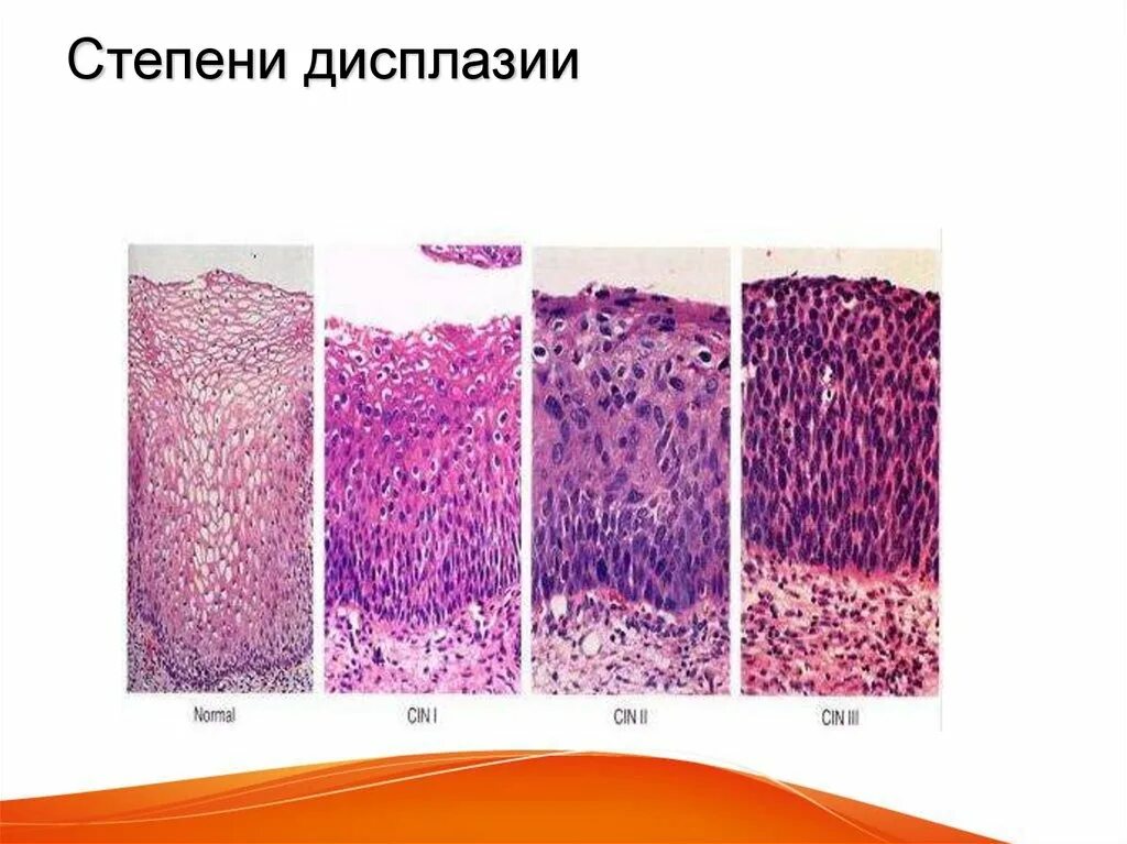 Плоскоклеточное интраэпителиальное поражение низкой. Дисплазия шейки матки микропрепарат. Дисплазия шейки гистология. Дисплазия матки гистология. Дисплазия эпителия гистология.