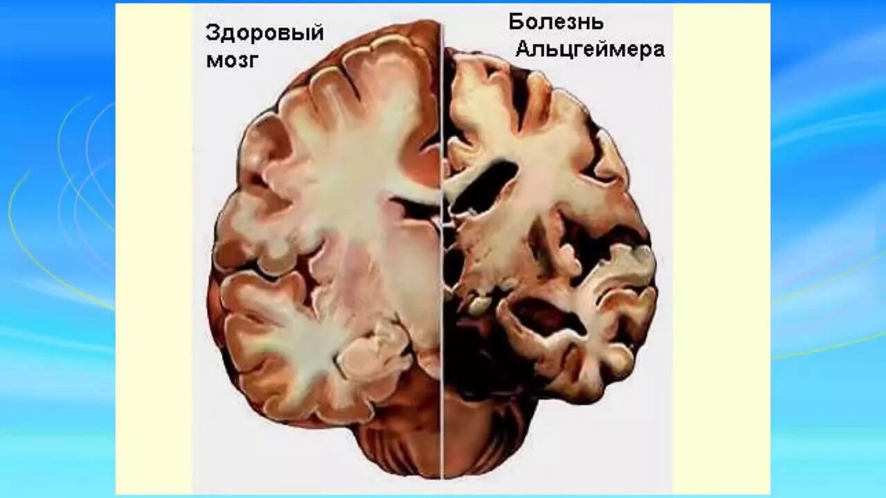 Мозг при альцгеймере. Мозг при альцгеймере. Мозг человека с болезнью альцгеймера. Болезнь альцгеймера. Болезнь альцгеймера.