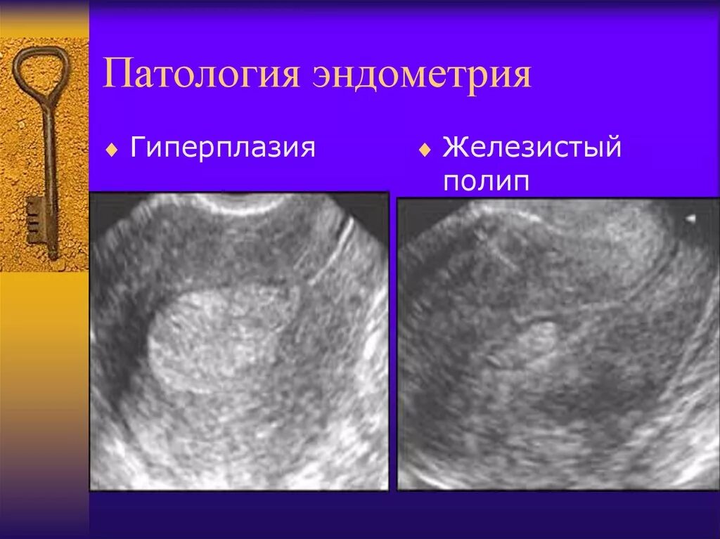 Гипопластическая эндометрия. Гиперплазия эндометрия эндометрит. Патология эндометрия гиперплазия эндометрия. Гиперплазия эндометрия МФЯ. Патология эндометрия гиперплазия.