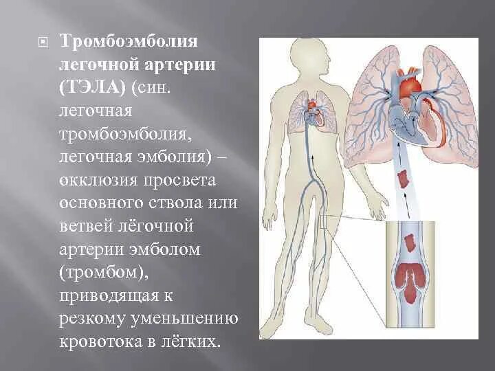 Тромбоэмболия мелких легочных ветвей. Тромбоэмболия легочной артерии. Источник эмболии легочной артерии.