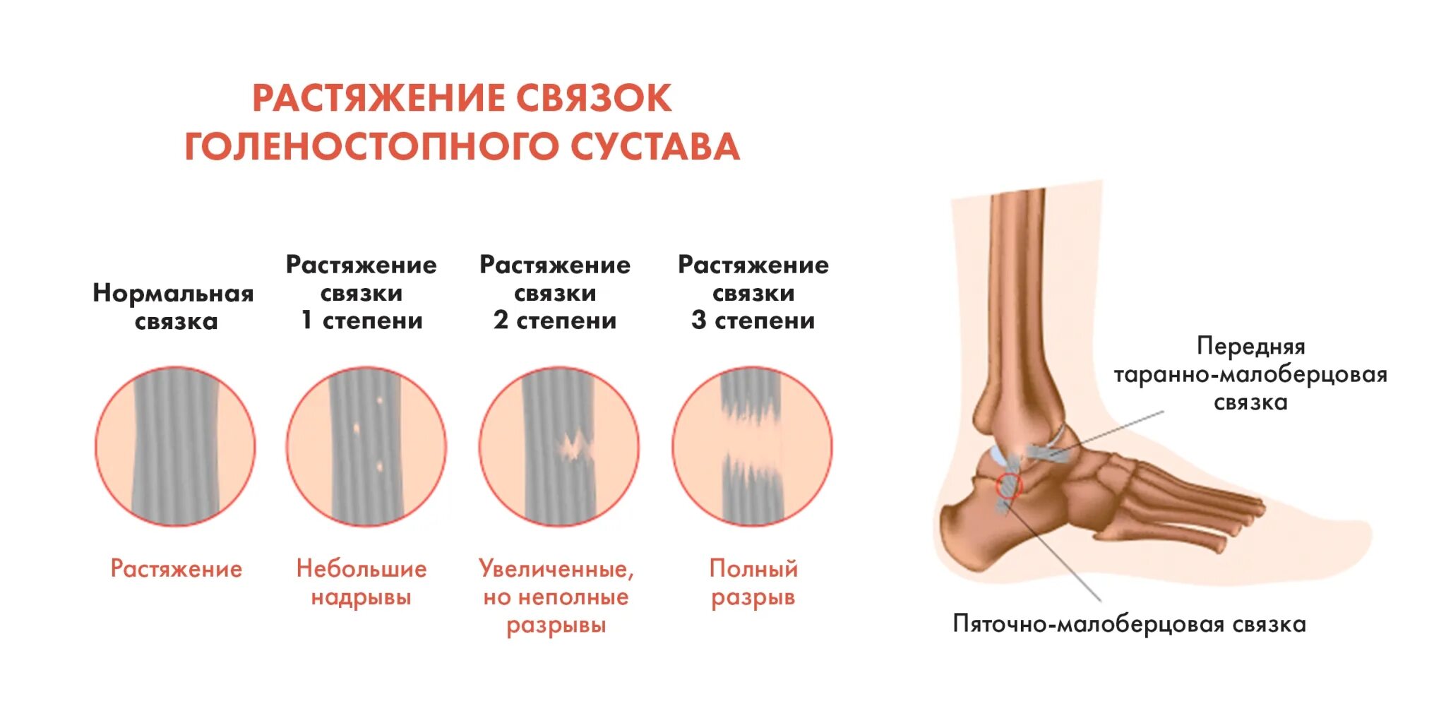 Дисторсия коленного