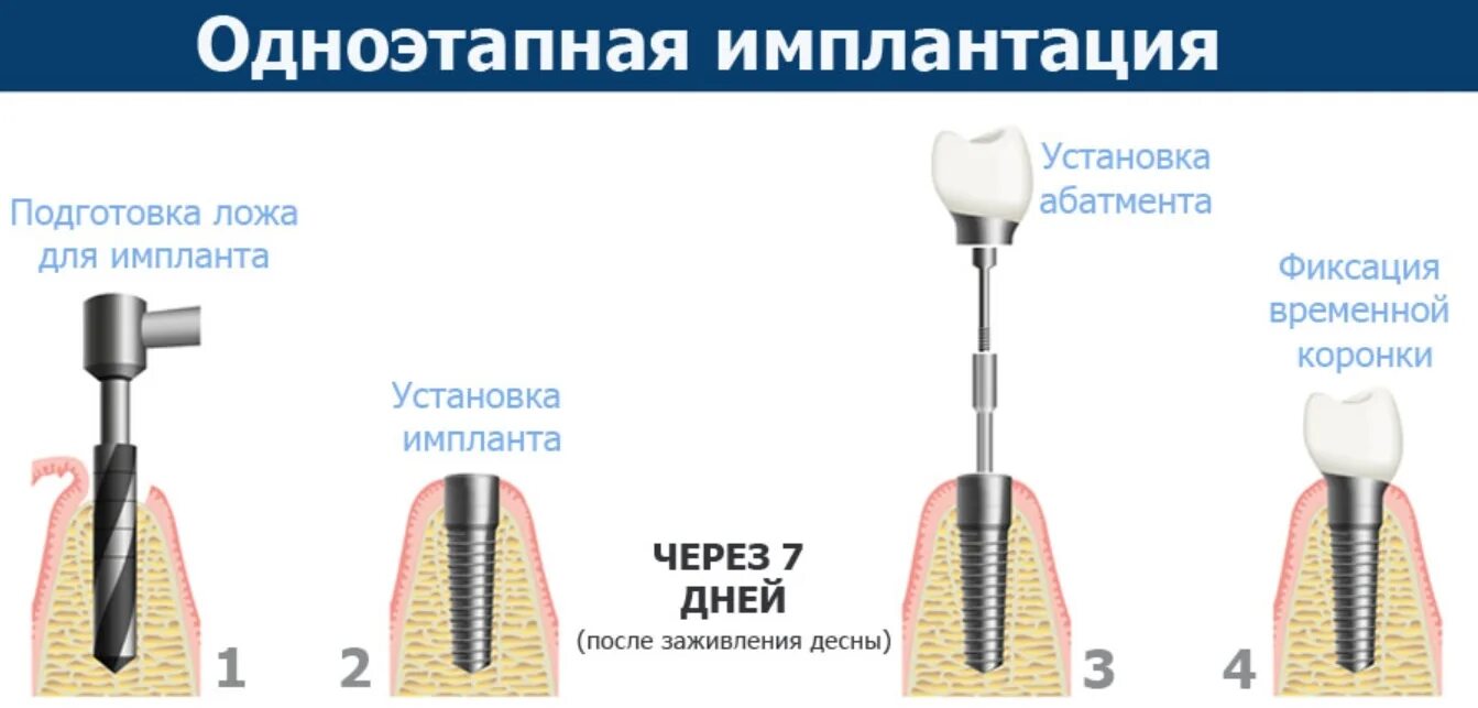 Двухэтапная методика имплантации. Метод одноэтапной имплантации. Импланты схема установки. Этапы имплантации зубов схема. Можно ставить импланты при диабете