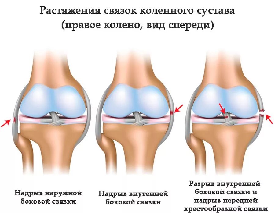 Травма связок сустава. Повреждение боковых связок коленного сустава. Перерастяжение связок коленного сустава. Растяжение сбоку коленного сустава. Разрыв боковой связки коленного сустава.