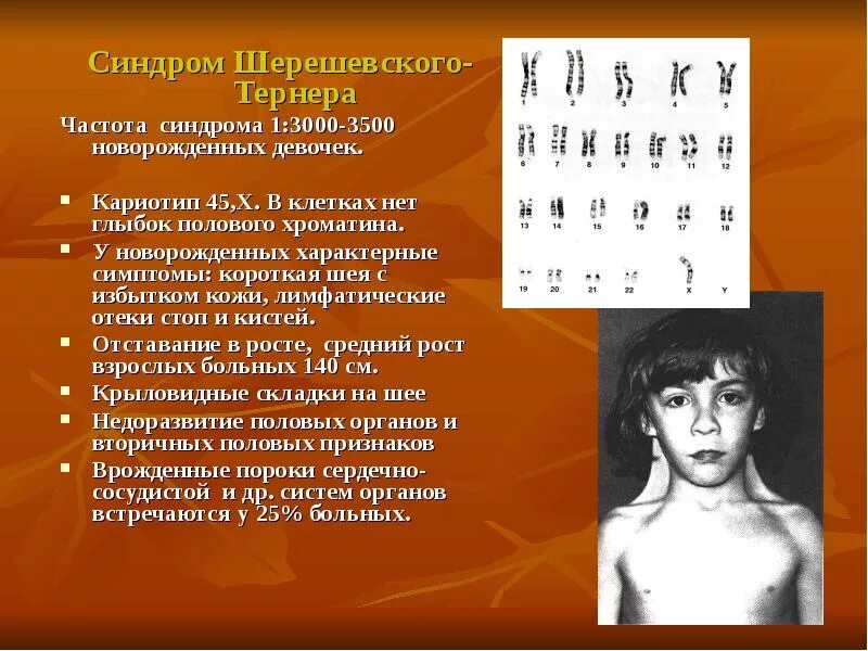 Кариотип девочки с синдромом шерешевского тернера. Шерешевский тернер кариотип. синдром шерешевского тернера кариотип. кариотип человека при синдроме шерешевского тернера. шерешевского-тёрнера кариотип 45.