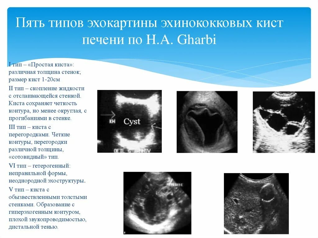 Simple Hepatic Cyst - Liver Case Studies - CTisus CT Scanning