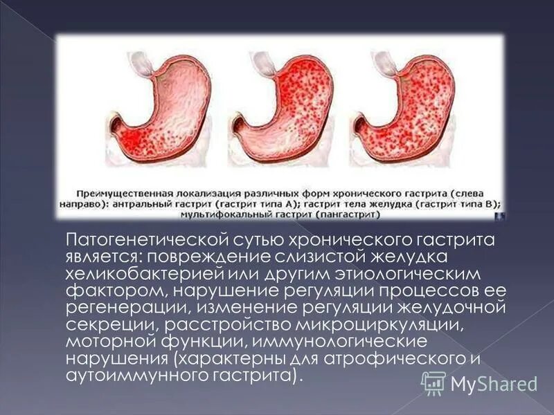 Возникновение язвы желудка. Степени хронического гастрита. Острый и хронический гастрит.