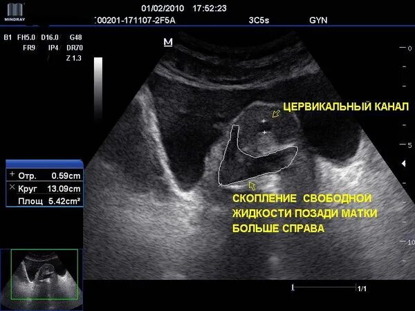 УЗИ малого таза снимок. Жидкость в маточной трубе на УЗИ. Жидкость в дугласовом пространстве на УЗИ норма. Жидкость в Малом тазу на УЗИ.