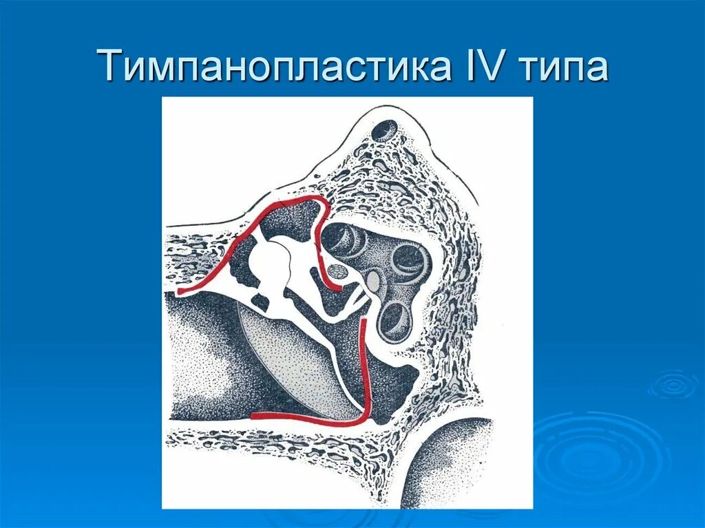 Тимпанопластика отзывы. Тимпанопластика по Вульштейну. Тимпанопластика классификация. Тимпанопластика по Мирко.