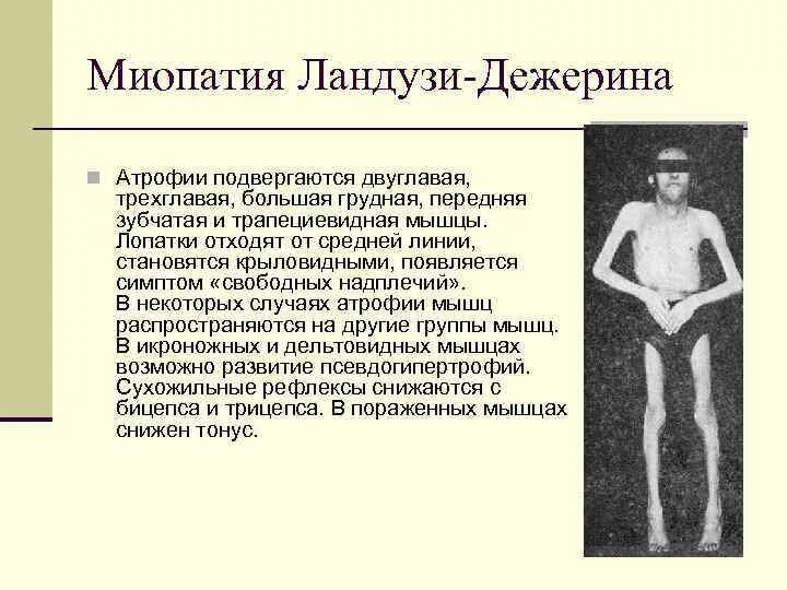 Миопатия ландузи дежерина. Миопатия поясно конечностная. Миопатия Дюшенна клинические проявления.