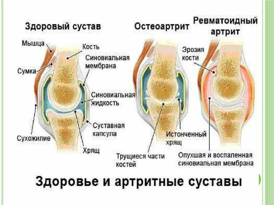 Ревматический артрит локализация. Локализация поражения суставов при ревматоидном артрите. Ревматоидный артрит коленного сустава. Ревматоидный артрит с доа это. Ревматоидный артрит мышцы
