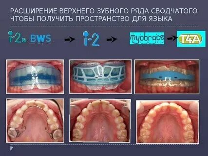 Верхний зубной ряд