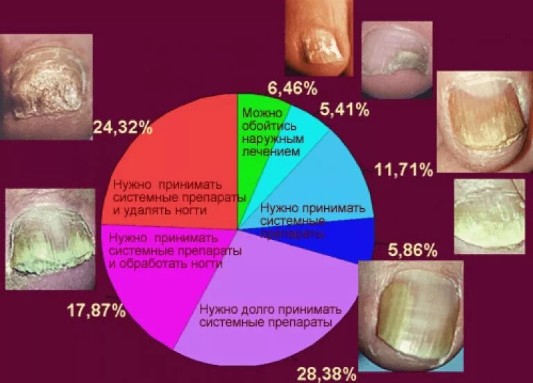 Сдать на какие грибки. Таблица инфекционные заболевания ногтей. Грибковые заболевания ногтей таблица. Грибковое поражение ногтей.