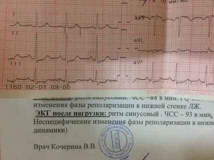 Экг нарушение процессов реполяризации нижней стенки