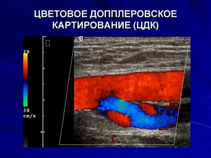 Цветной доплер