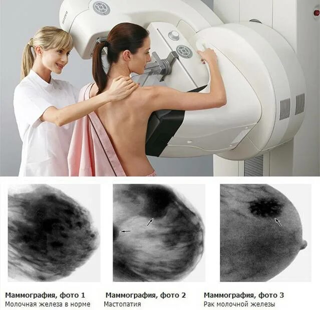 Маммография рентген снимки. Рентген молочных желез маммография аппарат. Маммография УЗИ молочных желез. Билатеральная маммография.