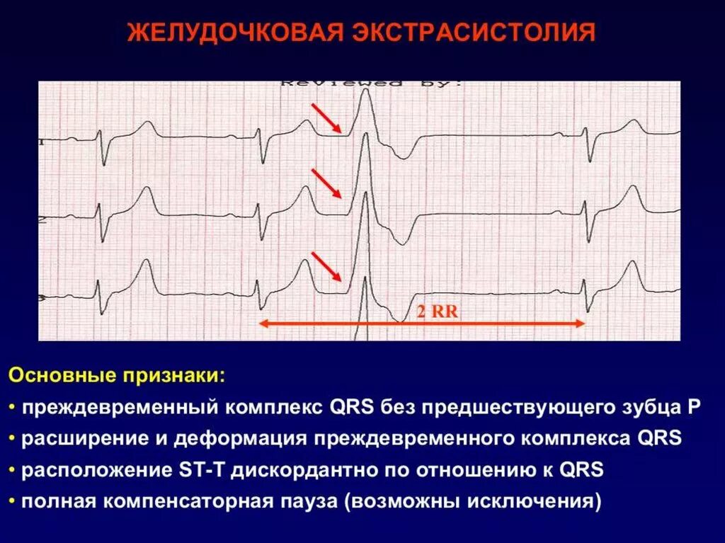 Экстрасистолы 4