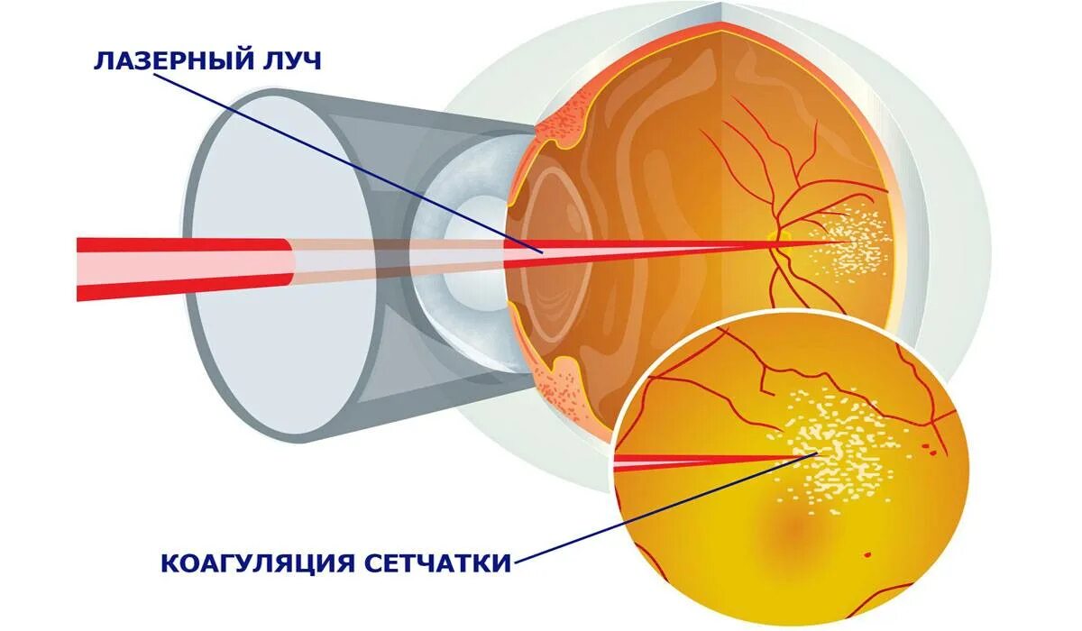 Лазерная коагуляция сетчатки глаза. Лазерная коагуляция сетчатки при диабетической ретинопатии. Периферическая лазерная коагуляция сетчатки. Периферическая лазеркоагуляция сетчатки ППЛК. Лазерная коагуляция после операции
