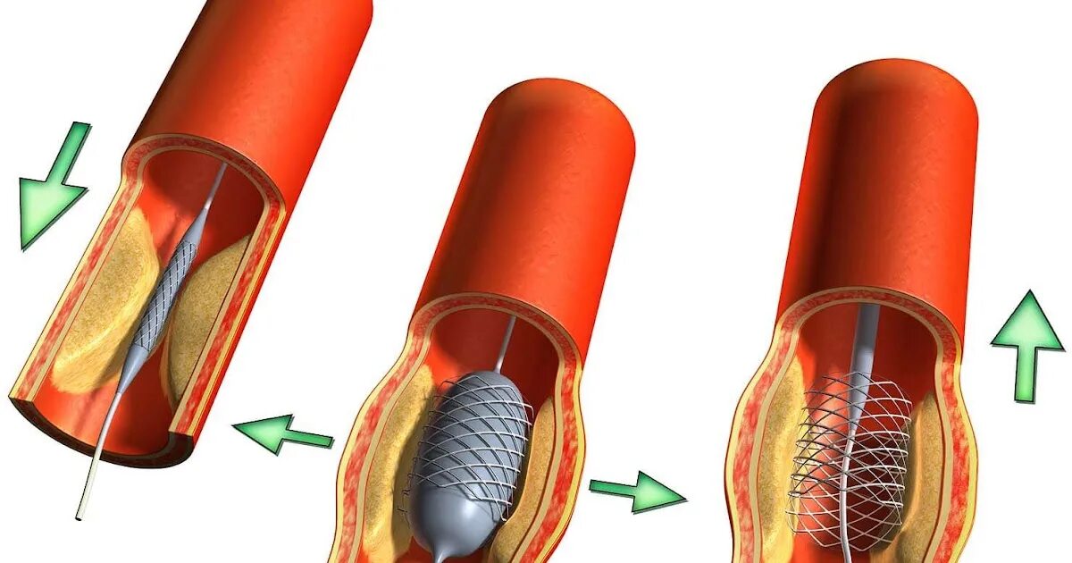 Шунт в медицине. Шунтирование, стентирование артерий. Шунтирование сердца и стентирование. Что такое шунтирование сосудов сердца и стентирование.