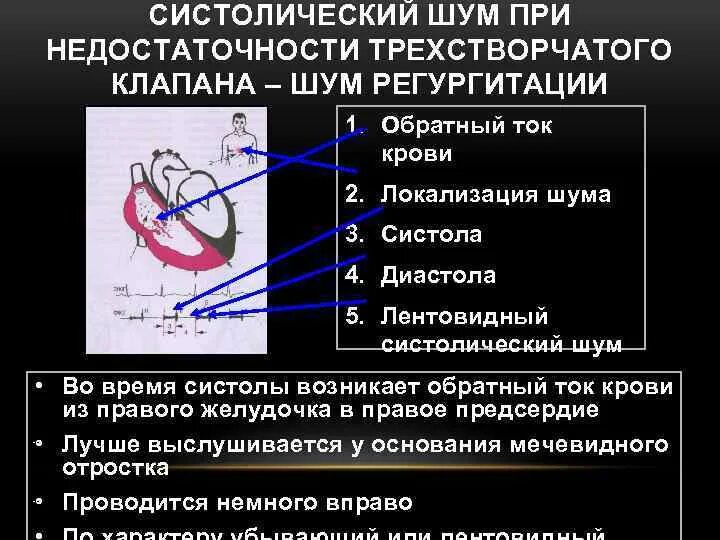 Шум при недостаточности трикуспидального клапана. Шум при недостаточности трехстворчатого клапана. Систолический шум при недостаточности трехстворчатого клапана. Систолический шум при недостаточности трикуспидального клапана. Систолический шум это