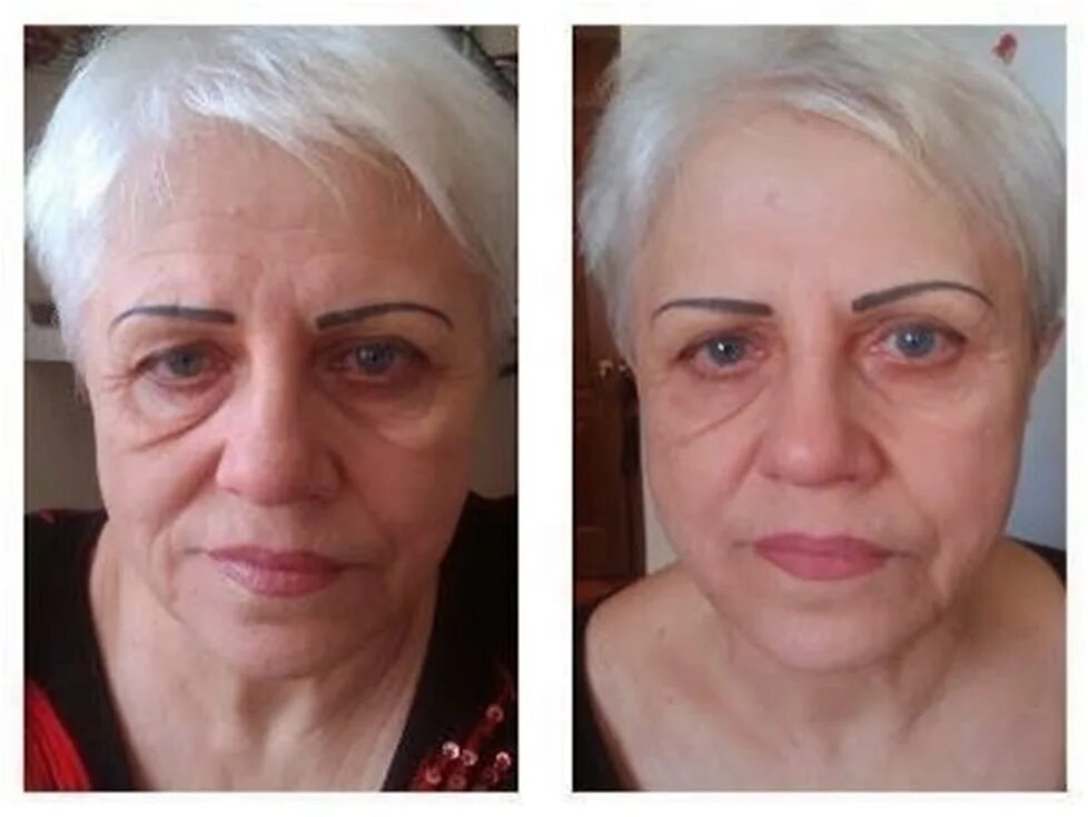 Микротоки лицо до и после фото отзывы. Микротоки для лица результат. микротоки для лица до и после. микротоки для лица lj b gjckt. микротоковая терапия лица до и после.