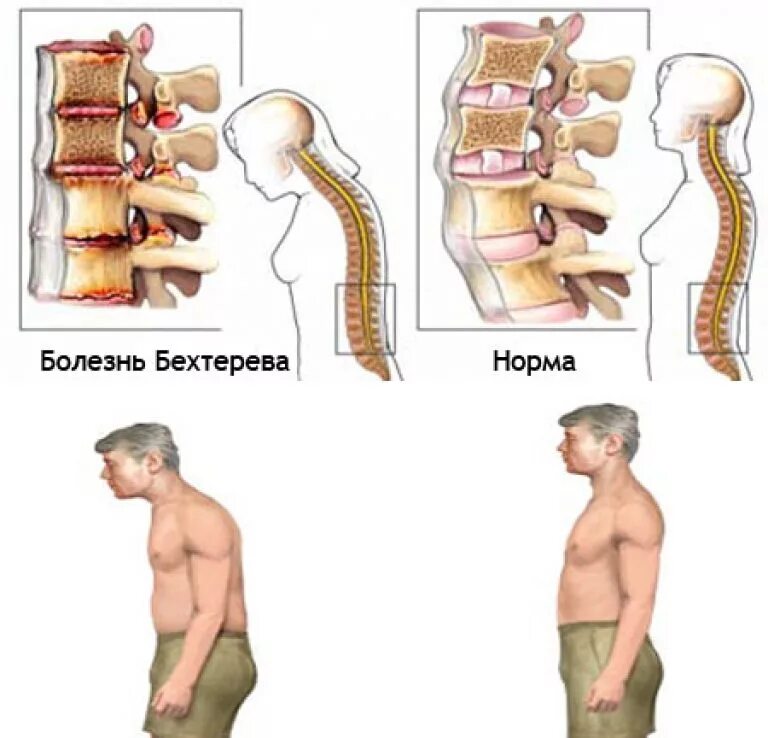 Изменение формы позвоночника. Анкилозирующий спондилит болезнь Бехтерева. Болезнь Бехтерева или анкилозирующий спондилоартрит;. Болезнь Бехтерева поясничный отдел позвоночника. Анкилозирующий спондилез это болезнь Бехтерева.