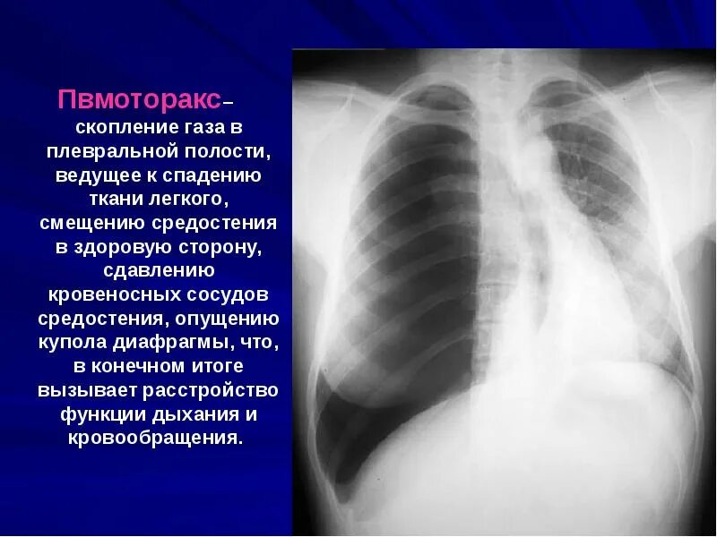 Закончился воздух в легких. Пневмоторакс и гидроторакс на рентгене. субтотальный пневмоторакс рентген. рентгеновский снимок пневмоторакс. пневмоторакс рентген снимки легких.